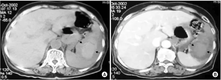 Fig.  2.  Pre-contrast  enhanced  abdominal  CT  scan  shows  a  heterogenous  high  attenuation  lesion  (arrow)  at  the  enlarged  spleen  (A)