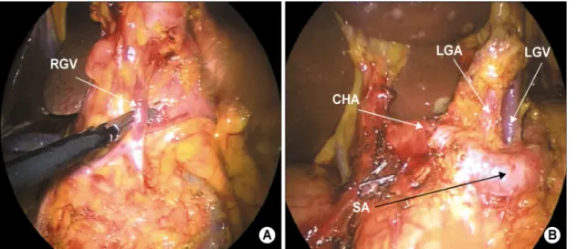 Fig.  1.  Intraoperative  findings  of  laparoscopy-assisted  gastrectomy  (LAG)  with  lymph  node  dissection  for  gastric  cancer  (A)  Right  gastroepiploic  vein  (RGV)  is  identified