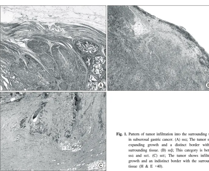 Fig.  1.  Pattern  of  tumor  infiltration  into  the  surrounding  tissue  in  subserosal  gastric  cancer