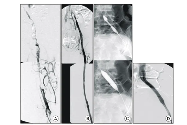 Fig.  2.  Result  of  thrombolysis  according  to  symptom  duration  No  complete  lysis  was  shown  in  case  of  more  than  10  days  of  symptom  duration  (P=0.004).