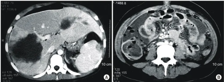 Fig.  1.  Abdominal  CT  scan  shows  homogenous  hypodense  mass  lesions  (diameter  7  cm,  and  11  cm)  in  both  hepatic  lobe  (A),  wall  thickening  of  terminal  ileum,  cecum  and  ascending  colon,  fluid  collection  at  pericolic  space,  and