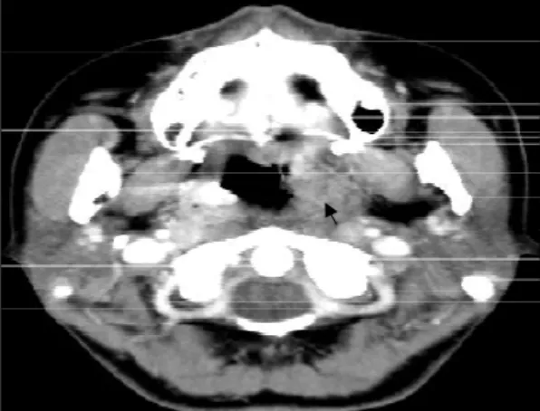 Fig. 4. Microscopically, the tumor is a mixture of mature adipose tissue, hyaline cartilage, and skin with skin  app-endages (arrow)(H &amp; E,  ×40)