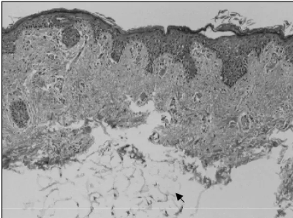 Fig. 5. At a higher magnification view, the surface of the mass is covered by the stratified squamous epithelia ( White arrow), and mature fat component (Black arrow) is seen in the lower portion of the microphotography ( H &amp; E,  ×100)