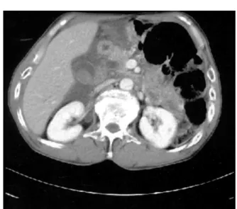 Fig.  1.  Contrast-enhanced  computed  tomographic  scan  demons- demons-trated  multiple  increased  densities  in  the  gallbladder,  suggesting  hematoma  within  the  lumen  of  the   gallblad-der  and  mogallblad-derate  amount  of  fluid  collection 