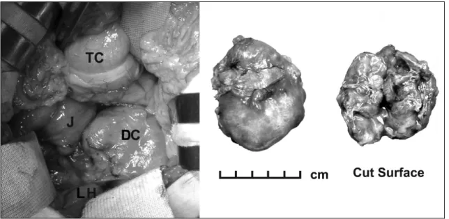 Fig.  1.  Abdominal  computed  tomographic  findings.  A  retroperitoneal  cystic  mass  with  internal  septa  is  located  at  medial  side  of  the  left  kidney  just  lateral  to  aorta