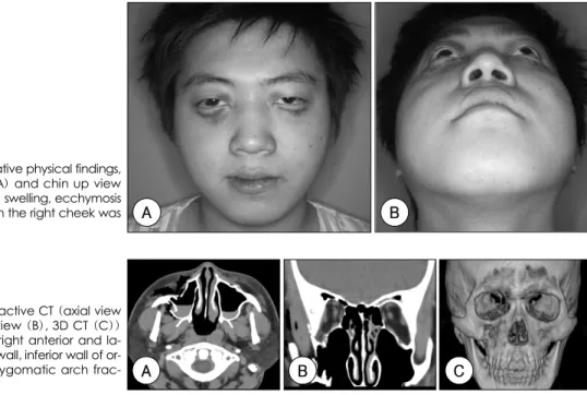 Fig. 2. Preoperactive CT (axial view (A), coronal view (B), 3D CT (C))