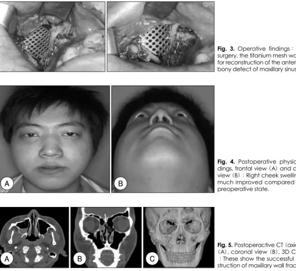 Fig. 4. Postoperative physical fin- fin-dings, frontal view (A) and chin up view (B)：Right cheek swelling was much improved compared to the preoperative state
