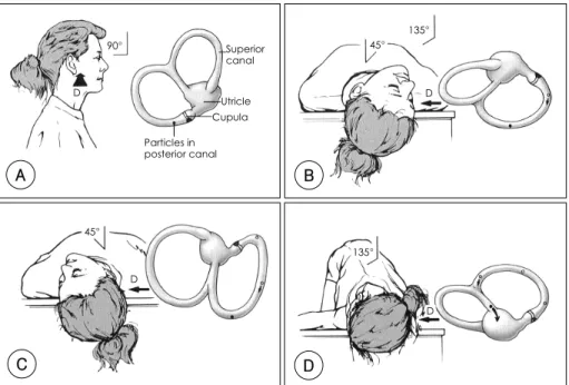 Fig. 7. Modified Epley maneuver (right ear). A：The patient is seated on a table as viewed from the right side