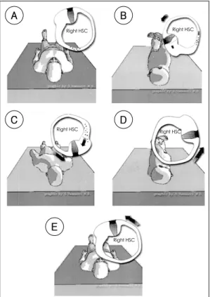 Fig. 7. Lempert positional maneuver for treatment of right lateral  se-micircular canal canalithiasis