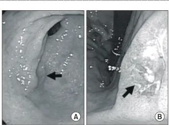 Fig.  3.  Endoscopic  Findings  of  stomach.  (A)  Gastrofiberscopic  finding  showed  erosion  located  in  anterior  wall  of  antrum