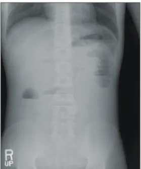Fig.  1.  Simple  abdomen  shows  the  mechanical  obstruction  of  the  small  bowel.