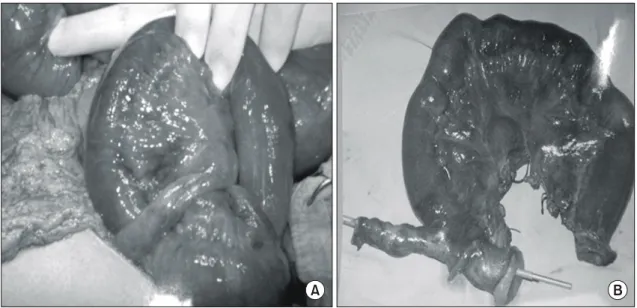 Fig.  2.  Abdominal  &amp;  pelvic  CT  shows  the  distal  small  bowel  obstruction  with  internal  herniation(arrow:  r/o  Meckel`s  diverticulum).