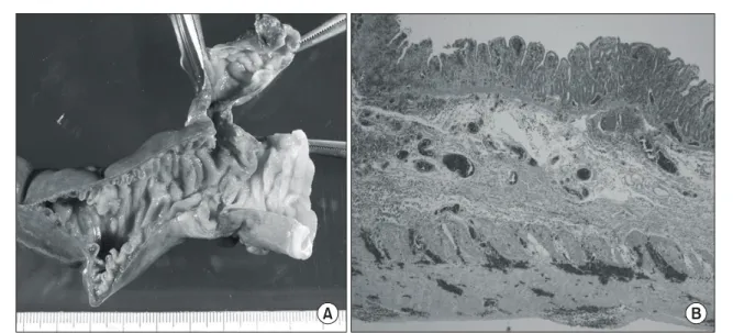 Fig.  4.  Pathologic  finding  shows  that  the  patent  omphalomesenteric  duct  consists  of  full  thickness  of  intestinal  wall  lined  by  small  intestinal  type  mucosa  with  focal  ischemic  necrosis  and  hemorrhage.