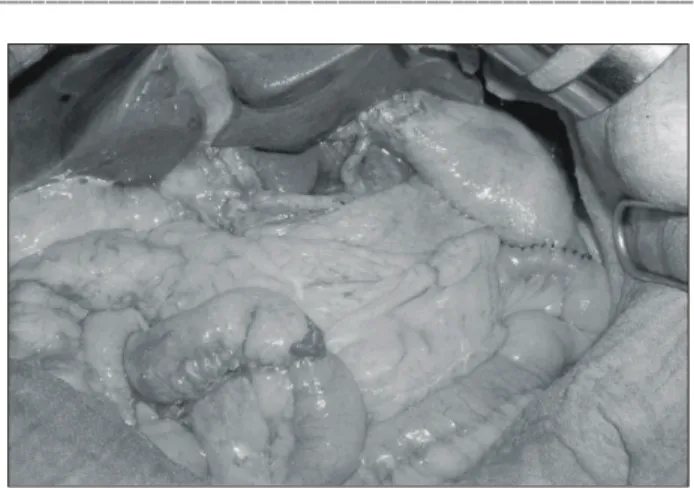 Fig.  5.  Operative  field.  After  dissection,  the  narrowed  ileum  was  seen.