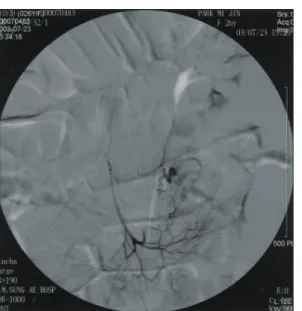 Fig.  2.  Resected  small  bowel  shows  an  area  of  transmural  ulcera- ulcera-tion  with  fresh  and  old  bleeding.