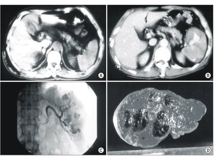 Fig.  4.  CT  scans  of  one  representative  patient  failed  non-operative  management  because  of  the  delayed  development  of  posttraumatic  splenic  artery  pseudoaneurysm