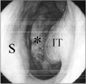 Fig. 2. Preoperative contrast enhan- enhan-ced CT scan of paranasal sinuses.