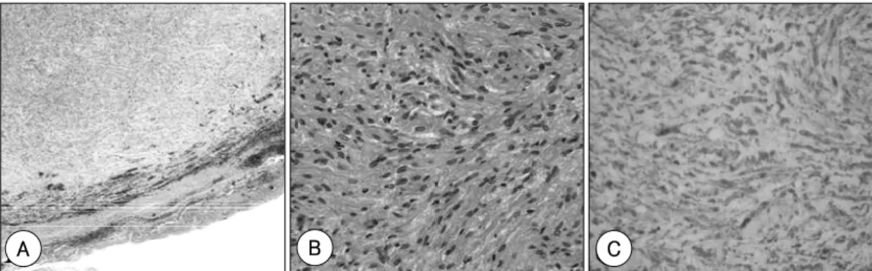 Fig. 3. Microscopic findings of the specimen. The tumor has relatively well demarcated margin and is surrounded by submucosal region of the nasal mucosa (A)(H &amp; E, ×40)