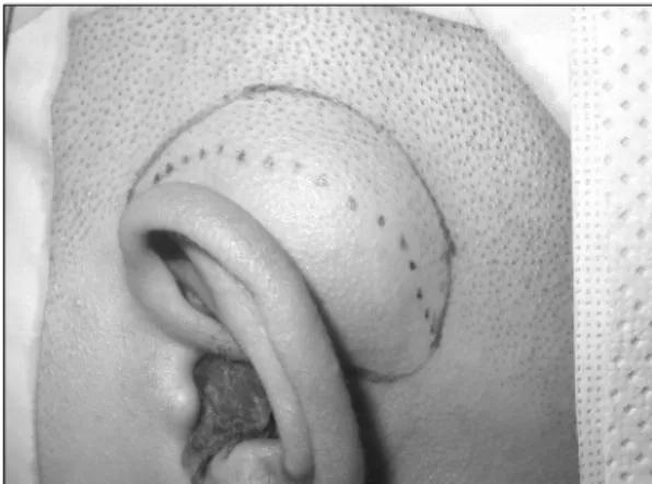 Fig. 3. Gross finding of the dermoid cyst after surgical exci- exci-sion. About 4.0×3.0×1.8 cm sized, rubbery consistency, cystic mass