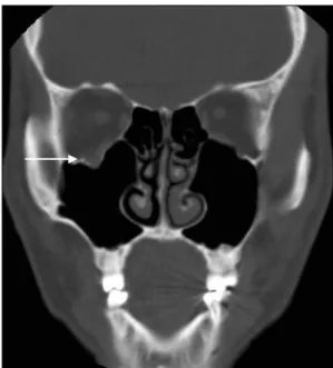 Fig. 2. Minor’s starch-iodine test shows a black discoloration on right  pre-auricular, forehead area