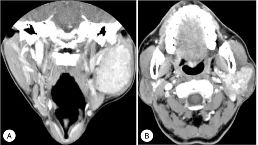 Fig. 2. Coronal (A) and Axial (B) fused PET/CT image shows intense localized FDG uptake (FDG SUV 8.81/6.90) in the whole left parotid gland