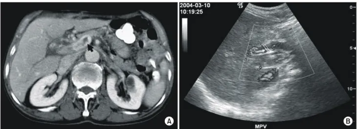 Fig.  2.  Follow  up  computed  tomographic  scan  showed  no  evidence  of  the  portal  vein  thrombosis  by  the  5th  week.