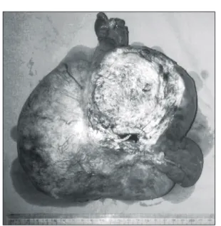 Fig.  3.  Partial  resected  desmoid  tumor  shows  adhered  perforated  small  bowel.
