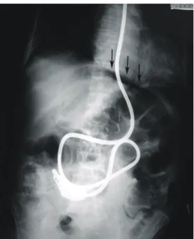Table  2.  Patient  data  and  intraoperative  findings  on  stercoral  perforation  of  the  colon