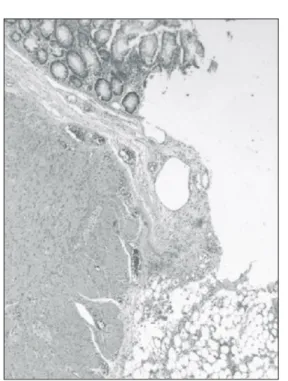 Fig.  2.  Pathological  specimen  of  the  resected  colonic  wall  around  the  perforation