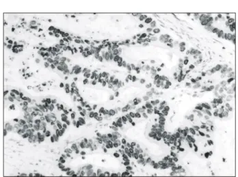 Fig.  2.  Immunohistochemical  staining  of  cyclin  B1.  Some  positive  cells  are  noted  in  the  adenocarcinoma  of  diffuse  type  (AEC, 