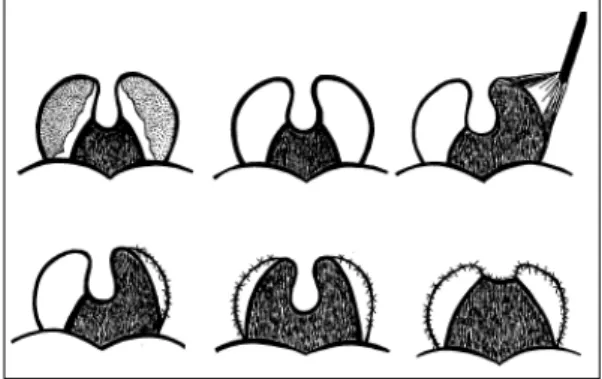 Fig. 3. Friedman classification of palatal position (A) and tonsil size (B). The Friedman palate position is based on visualization of structures in the mouth with the mouth open widely without protrusion of the tongue
