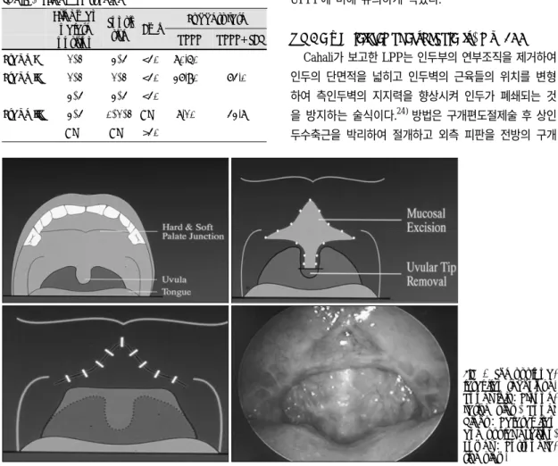 Fig. 4. The uvulopa- uvulopa-latal flap technique. 