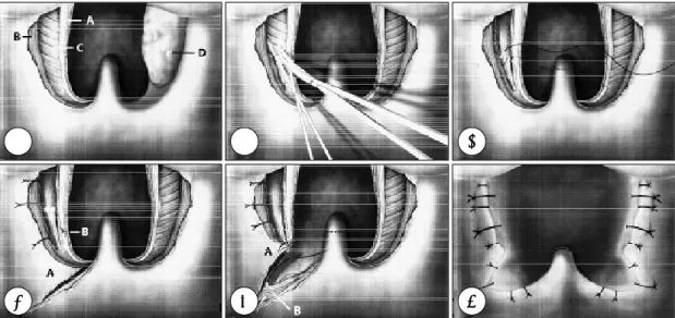 Fig. 5. The lateral pharyngoplasty technique. ① Operative view after left tonsillectomy