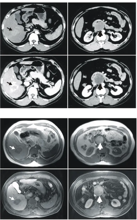 Fig.  1.  Preoperative  CT  scan  showed  3.4  cm  sized  peripheral   en-hanced  mass  on  S6  of  liver  (small  arrow),  and  4.7  cm  sized  well  encapsulated  low  attenuated  mass  in  posterior  aspect  of  third  portion  of  duodenum  (large  arr