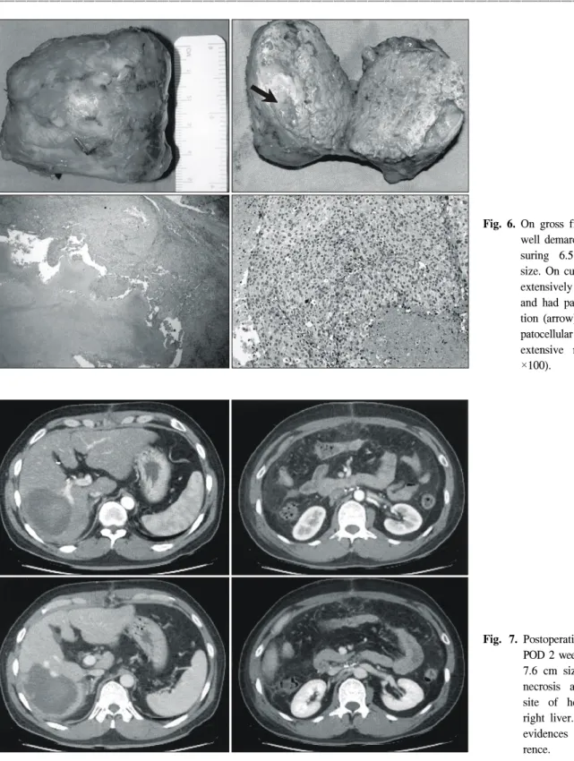 Fig.  6.  On  gross  finding,  it  was  a  well  demarcated  mass   mea-suring  6.5×5×3.5  cm  in  size