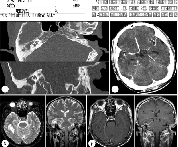 Fig. 1. Imaging study in a case of brain abscess (case 7). A：Temporal bone CT；Total haziness in right mastoid cavity and tegmen erosion are seen, B：Brain CT (enhance)；There is no abnormal enhancement in brain parenchyma, C：Brain MRI, T2-weighted image；Irre