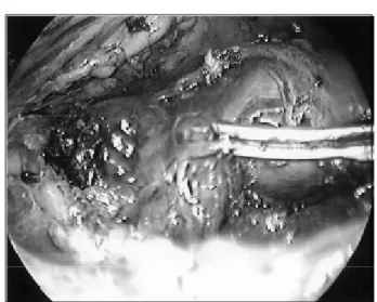 Fig.  2.  This  shows  a  finding  of  thyroid  removed  from  trachea.