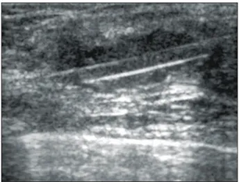 Fig.  2.  Sonogram  obtained  during  MT  excision  show  8  g  probe  positioned  in  breast  with  collecting  area  of  probe  deep  in 