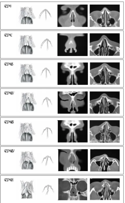 Fig. 1. Classification of nasal bone fracture.  Type 0 Type I  Type IIo Type IIs  Type IIIo Type IIIs Type IV 