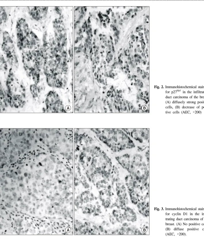 Fig.  2.  Immunohistochemical  staining  for  p27 kip1   in  the  infiltrating  duct  carcinoma  of  the  breast