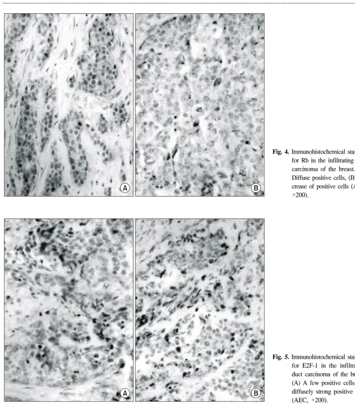 Fig.  4.  Immunohistochemical  staining  for  Rb  in  the  infiltrating  duct  carcinoma  of  the  breast