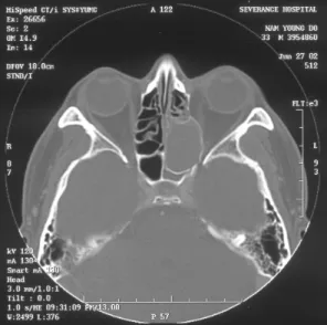 Fig. 4. Visual evoked poten- poten-tial findings shows no  res-ponse in left eye (arrow)