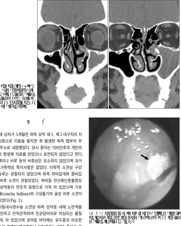 Fig. 2. 70 degree endoscopic finding. Whitish material is  protruded through the edematous mucosa on the left  maxillary sinus floor (arrow)