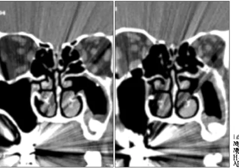 Fig. 3. Follow up coronal CT  scan. A mass with bony  den-sity is observed on the left  maxillary sinus floor  surroun-ded with soft tissue density