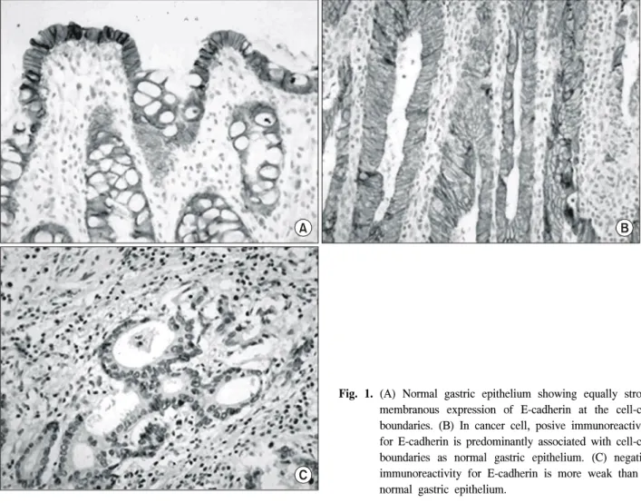Fig.  1.  (A)  Normal  gastric  epithelium  showing  equally  strong  membranous  expression  of  E-cadherin  at  the  cell-cell  boundaries