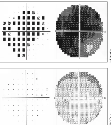 Fig. 1. Visual field analysis test (preo- (preo-perative state). The visual field was  much limited due to optic nerve  compression