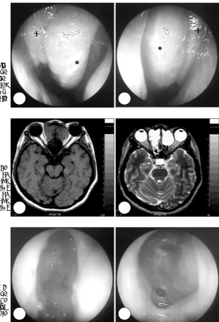Fig. 1. Preoperative endoscopic fin- fin-ding of right nasal cavity (A) and  left nasal cavity (B) shows laser  ind-uced scars in both middle turbinates  (*) and polypoid change in the  an-terior wall of the anan-terior ethmoid