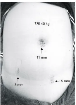 Table  1.    Indications  for  laparoscopic  surgery  in  children  mean  age  and  operative  time