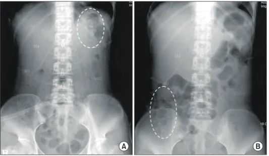 Fig.  3.  Postoperative  pain.  Postoperative  pain  was  measured  with  a  VAS  (visual  analog  scale),  and  it  was  significantly  lower  in  the  LG  group  than  that  in  the  OG  group.