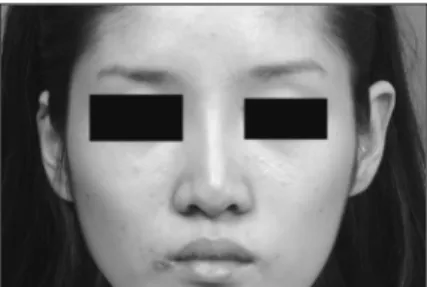 Fig. 21. 파라핀 삽입 후에 콧등 피부의 불균일과 붉어짐을  주소로 내원한 환자  (A). En-block으로 제거한 파라핀 (B),  파라핀을 제거하는 수술 중 너무 피부쪽으로 dissection하 여 피부가 perforation된 사진  (C)